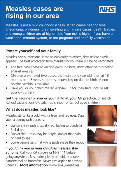 Measles info